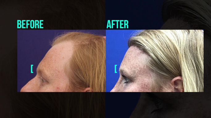 Toby Mayer - Orbital Bony Contouring